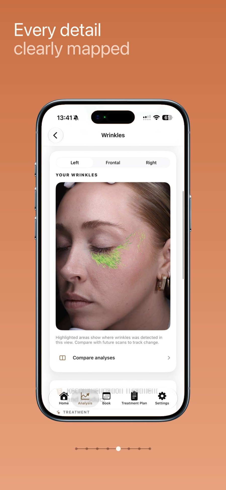 VISIA feature overlay highlighting where wrinkles were detected